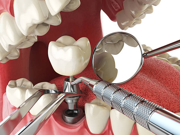 Best Knocked-Out Tooth (Avulsed Tooth) Treatment in North Fort Myers, FL